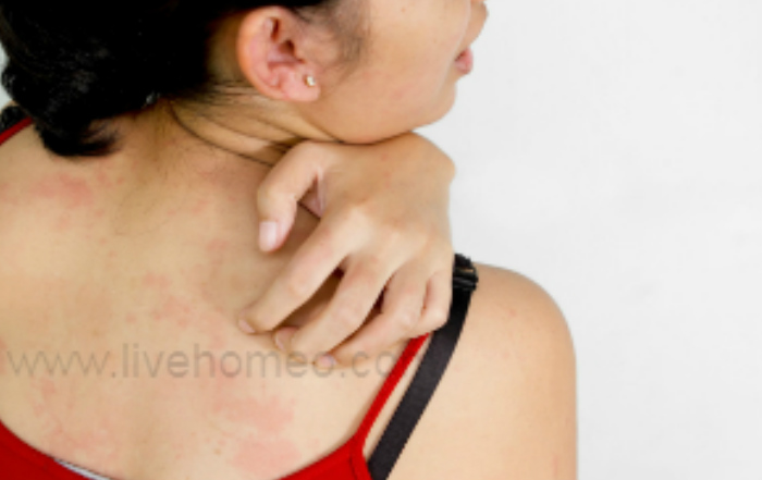 Skin Allergies Prevention Tips