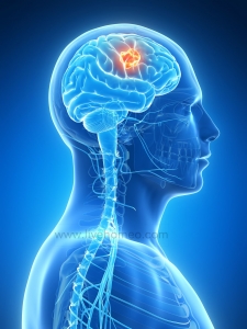 Homeopathy Tips for Glioblastoma Disorders