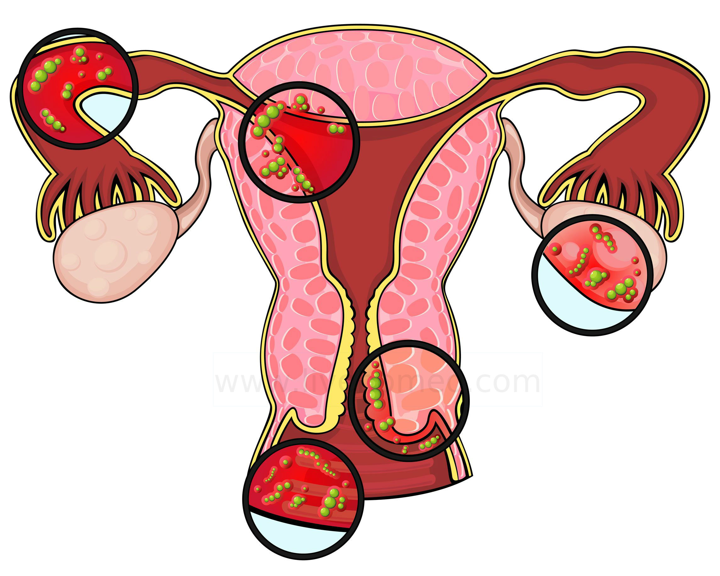 Gynaecological Disorders tips to Overcome it