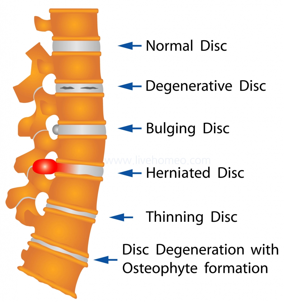 Health Tips for Spinal Disc Problems