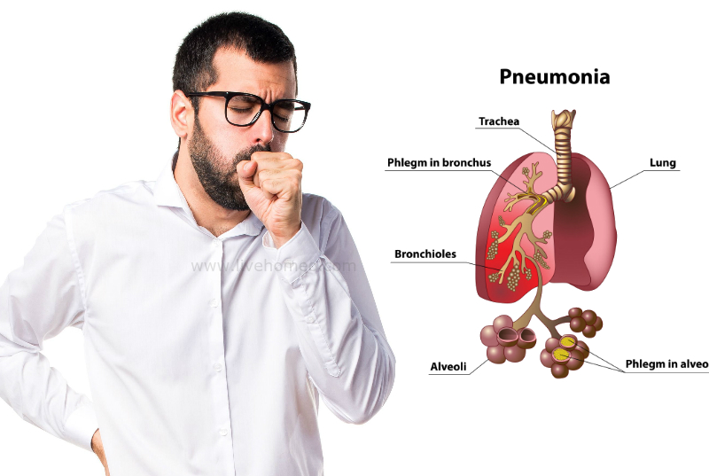 Pneumonia Disorder