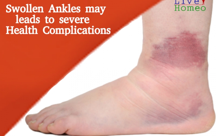 Problems with Swollen Ankles