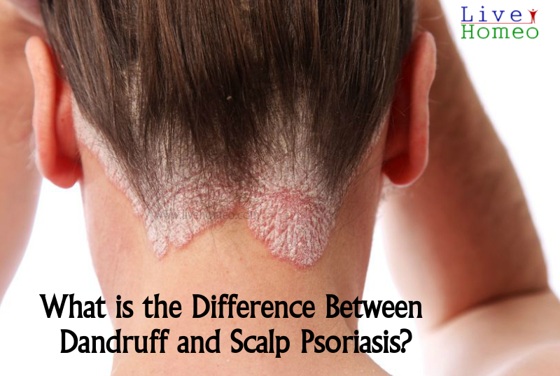 Causes of Scalp Psoriasis
