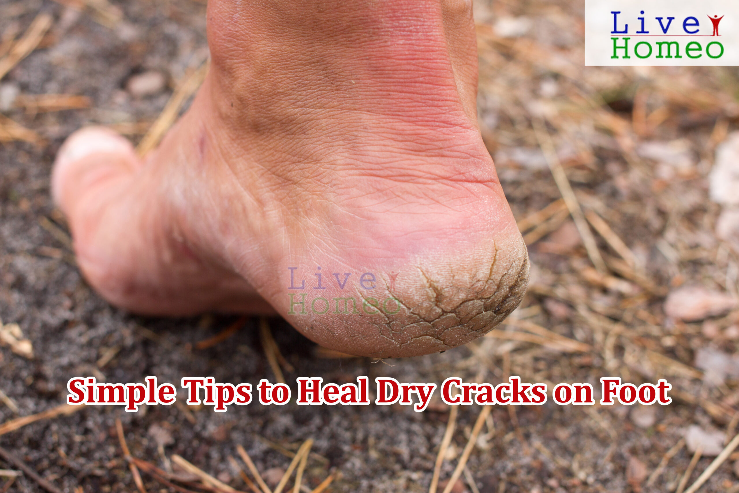 Simple Tips to Heal Dry Cracks on Foot