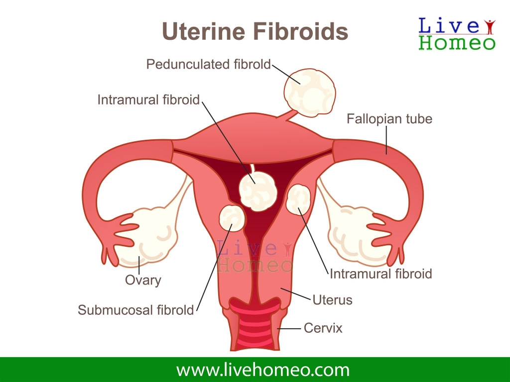 Homeopathy Treatment for Uterine Fibroids