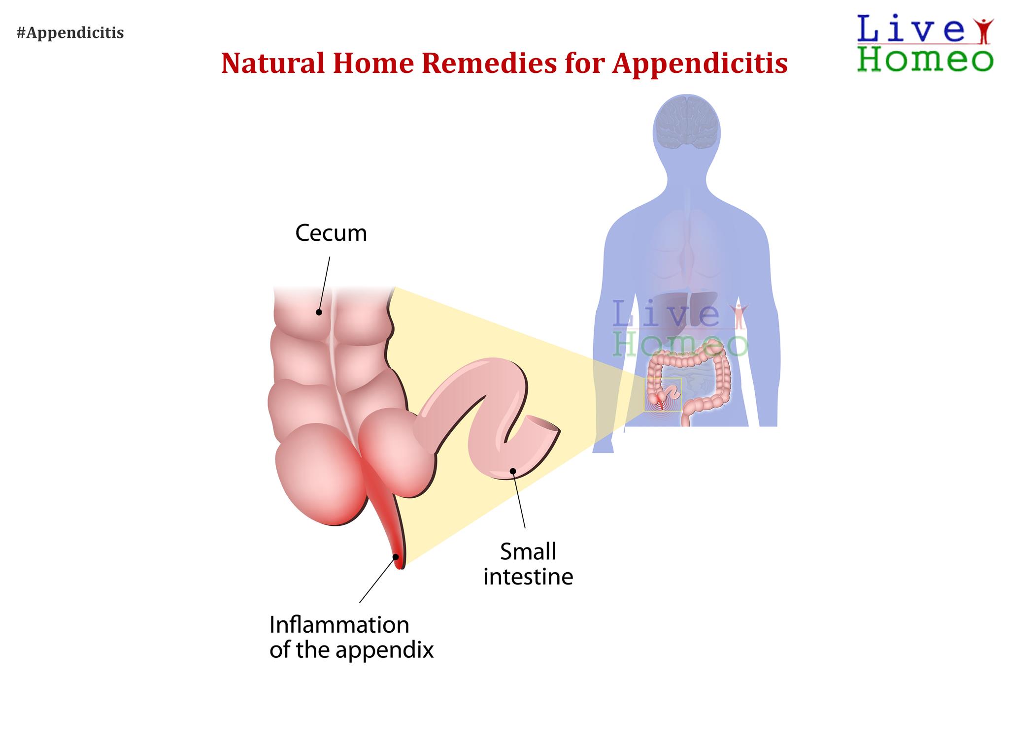 Natural Home remedies for Appendicities