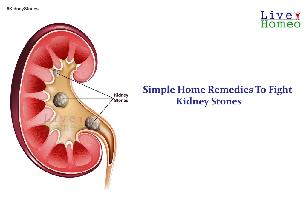 Simple home remedies to figh kidney stones